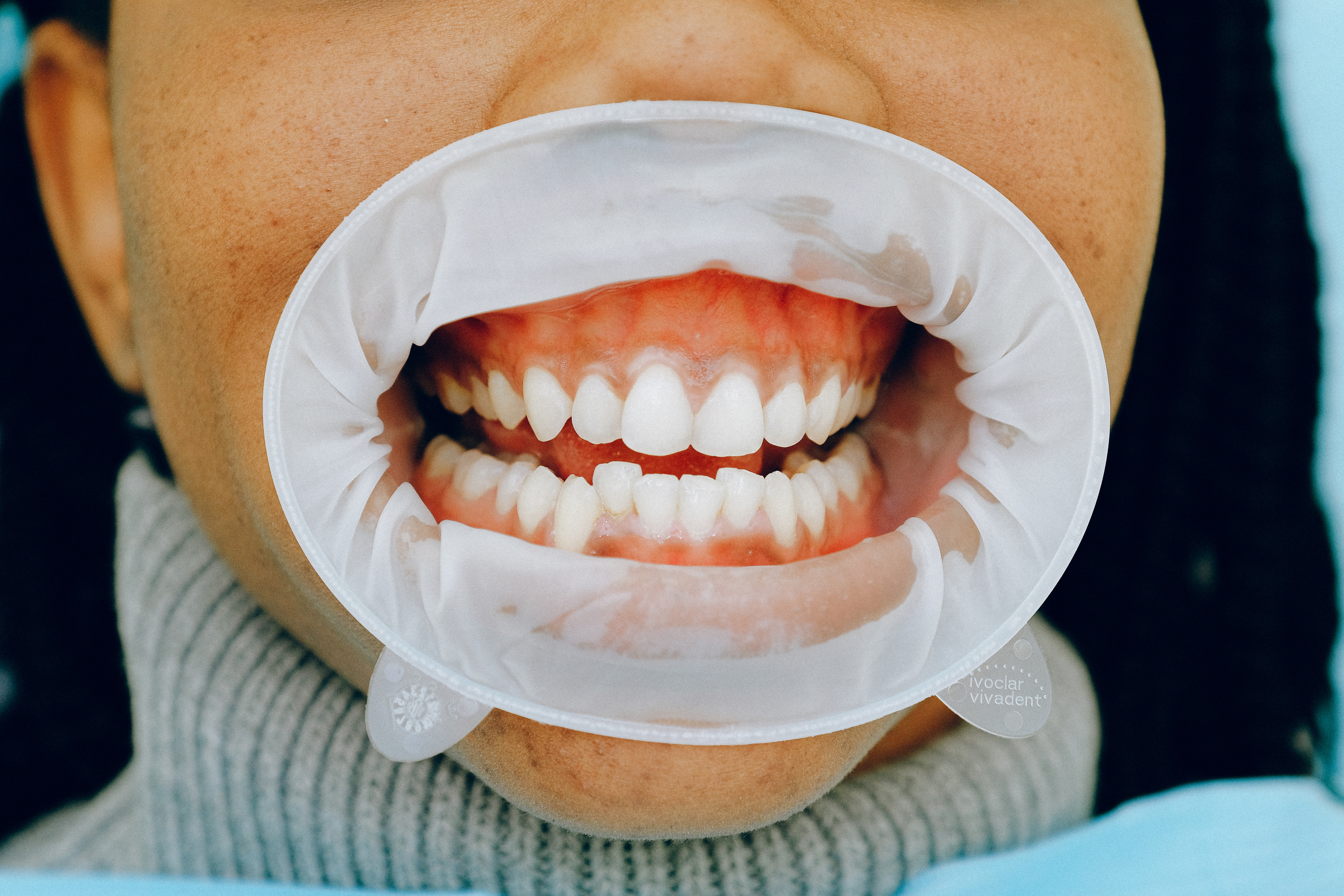 Ultrasonic tartar removal at Medicodent Dental Clinic, Sződliget