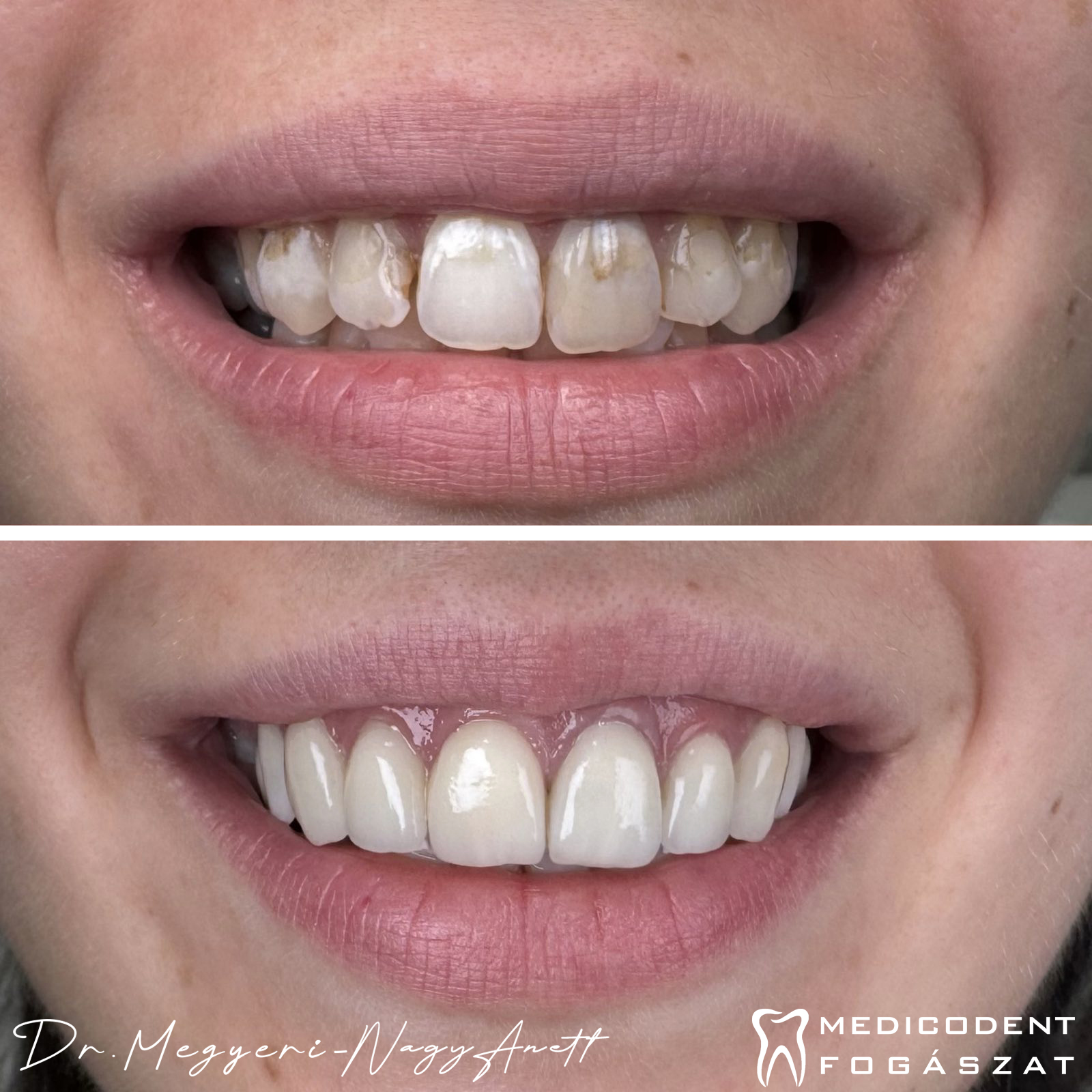 Mouth rehabilitation before-after: e-max pressed ceramic veneers – Dr. Anett Megyeri-Nagy, Medicodent Sződliget