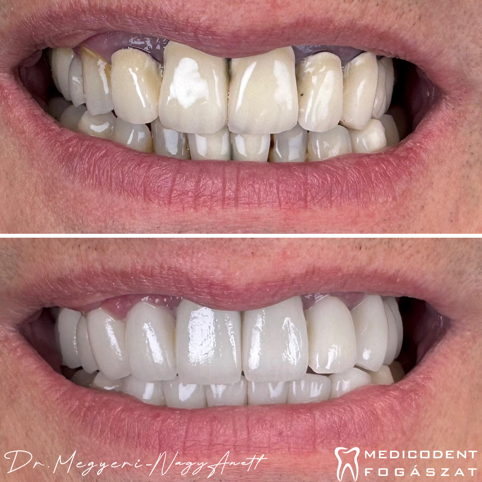 Full mouth rehabilitation before-after: zirconia crowns – Dr. Anett Megyeri-Nagy, Medicodent Sződliget