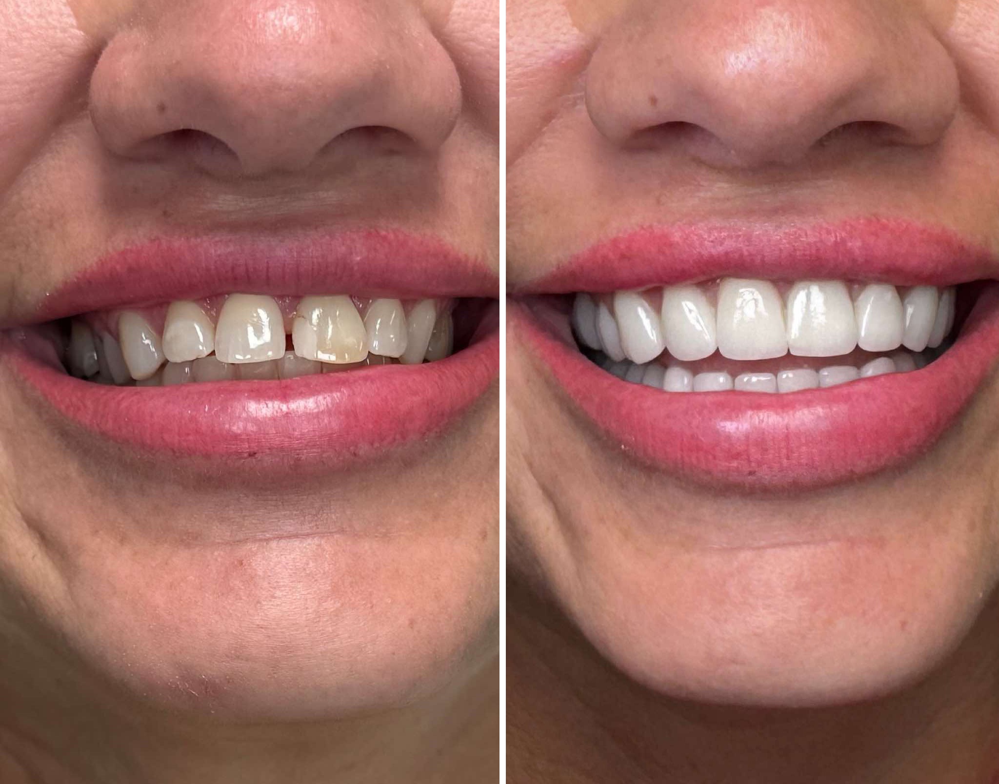 Full mouth rehabilitation before-after: bite raising and zirconia crowns – Dr. Anett Megyeri-Nagy, Medicodent Sződliget